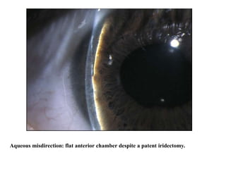 Aqueous misdirection: flat anterior chamber despite a patent iridectomy. 81
 