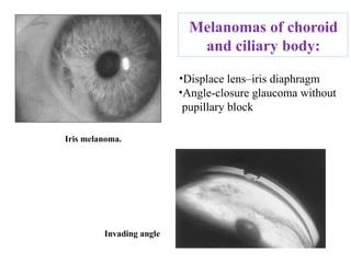 
Iris melanoma.
Invading angle
Melanomas of choroid
and ciliary body:
•Displace lens–iris diaphragm
•Angle-closure glaucoma without
pupillary block
 