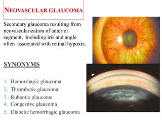 NEOVASCULAR GLAUCOMA
Secondary glaucoma resulting from
neovascularization of anterior
segment, including iris and angle
often associated with retinal hypoxia.
SYNONYMS
1. Hemorrhagic glaucoma
2. Thrombotic glaucoma
3. Rubeotic glaucoma
4. Congestive glaucoma
5. Diabetic hemorrhagic glaucoma
9
 