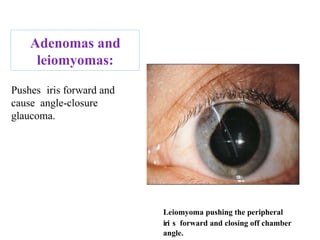 Leiomyoma pushing the peripheral
iri9s1 forward and closing off chamber
angle.
Adenomas and
leiomyomas:
Pushes iris forward and
cause angle-closure
glaucoma.
 