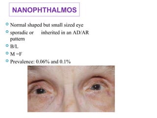 NANOPHTHALMOS
 Normal shaped but small sized eye
 sporadic or inherited in an AD/AR
pattern
 B/L
 M =F
 Prevalence: 0.06% and 0.1%
 
