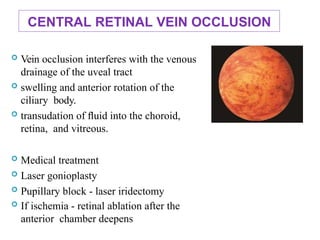 CENTRAL RETINAL VEIN OCCLUSION
 Vein occlusion interferes with the venous
drainage of the uveal tract
 swelling and anterior rotation of the
ciliary body.
 transudation of ﬂuid into the choroid,
retina, and vitreous.
 Medical treatment
 Laser gonioplasty
 Pupillary block - laser iridectomy
 If ischemia - retinal ablation after the
anterior chamber deepens
100
 