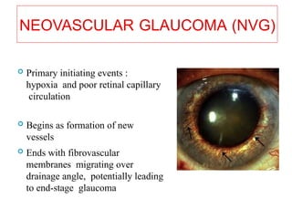 NEOVASCULAR GLAUCOMA (NVG)
 Primary initiating events :
hypoxia and poor retinal capillary
circulation
 Begins as formation of new
vessels
 Ends with fibrovascular
membranes migrating over
drainage angle, potentially leading
to end-stage glaucoma 10
 