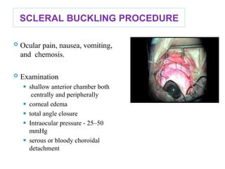 SCLERAL BUCKLING PROCEDURE
 Ocular pain, nausea, vomiting,
and chemosis.
 Examination
⚫ shallow anterior chamber both
centrally and peripherally
⚫ corneal edema
⚫ total angle closure
⚫ Intraocular pressure - 25–50
mmHg
⚫ serous or bloody choroidal
detachment 101
 