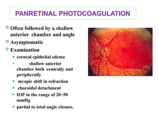 PANRETINAL PHOTOCOAGULATION
 Often followed by a shallow
anterior chamber and angle
 Asymptomatic
 Examination
⚫ corneal epithelial edema
⚫ shallow anterior
chamber both centrally and
peripherally
⚫ myopic shift in refraction
⚫ choroidal detachment
⚫ IOP in the range of 20–50
mmHg
⚫ partial to total angle closure.
103
 