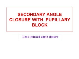 SECONDARY ANGLE
CLOSURE WITH PUPILLARY
BLOCK
Lens-induced angle closure
 