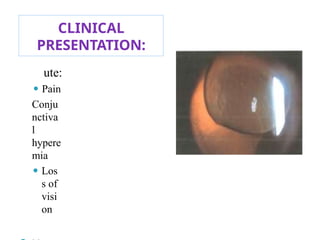 CLINICAL
PRESENTATION:
ute:
⚫ Pain
Conju
nctiva
l
hypere
mia
⚫ Los
s of
visi
on 110
 