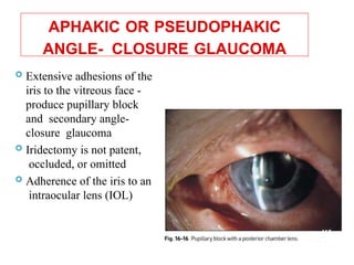 APHAKIC OR PSEUDOPHAKIC
ANGLE- CLOSURE GLAUCOMA
 Extensive adhesions of the
iris to the vitreous face -
produce pupillary block
and secondary angle-
closure glaucoma
 Iridectomy is not patent,
occluded, or omitted
 Adherence of the iris to an
intraocular lens (IOL)
112
 
