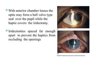  With anterior chamber lenses the
optic may form a ball valve type
seal over the pupil while the
haptic covers the iridectomy.
 Iridectomies spaced far enough
apart to prevent the haptics from
occluding the openings
113
 