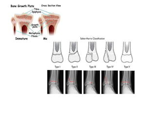 17.FRACTURE MANAGEMENT bds 2.pptx orthopedics | PPTX