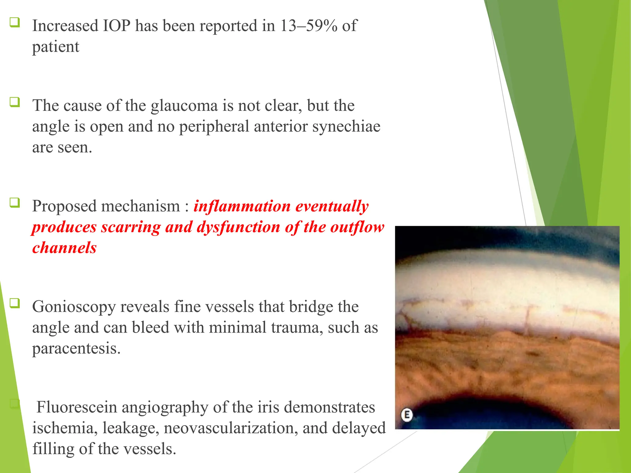  Increased IOP has been reported in 13–59% of
patient
 The cause of the glaucoma is not clear, but the
angle is open and no peripheral anterior synechiae
are seen.
 Proposed mechanism : inflammation eventually
produces scarring and dysfunction of the outflow
channels
 Gonioscopy reveals fine vessels that bridge the
angle and can bleed with minimal trauma, such as
paracentesis.
 Fluorescein angiography of the iris demonstrates
ischemia, leakage, neovascularization, and delayed
filling of the vessels.
 