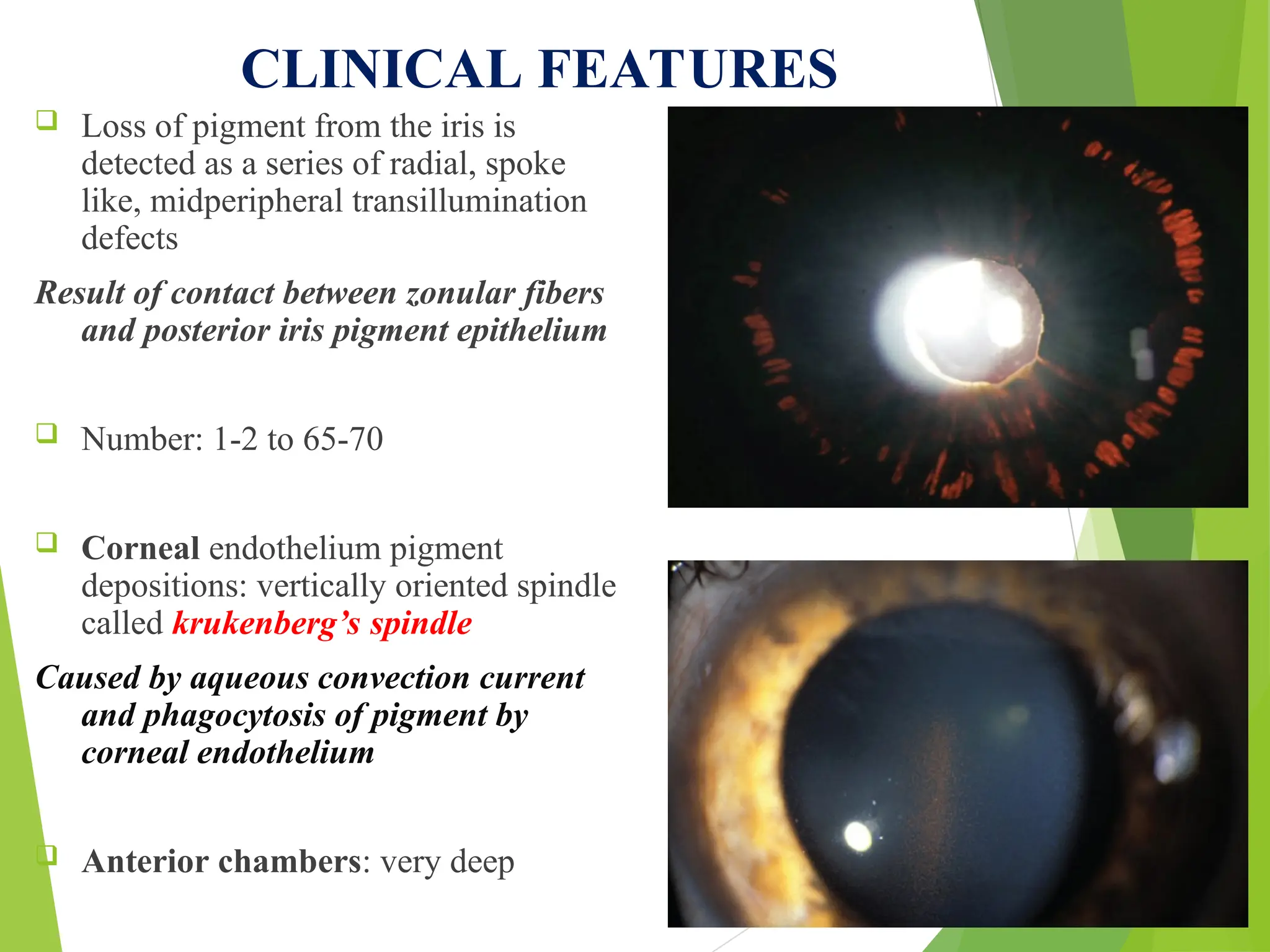 CLINICAL FEATURES
 Loss of pigment from the iris is
detected as a series of radial, spoke
like, midperipheral transillumination
defects
Result of contact between zonular fibers
and posterior iris pigment epithelium
 Number: 1-2 to 65-70
 Corneal endothelium pigment
depositions: vertically oriented spindle
called krukenberg’s spindle
Caused by aqueous convection current
and phagocytosis of pigment by
corneal endothelium
 Anterior chambers: very deep
 