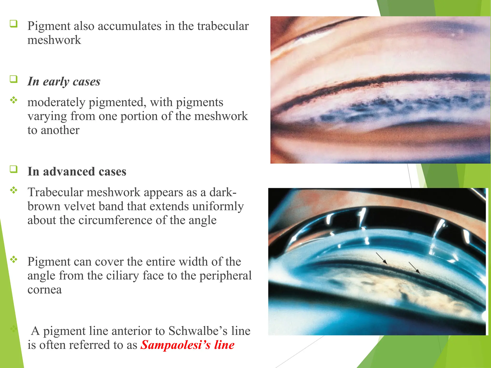  Pigment also accumulates in the trabecular
meshwork
 In early cases
 moderately pigmented, with pigments
varying from one portion of the meshwork
to another
 In advanced cases
 Trabecular meshwork appears as a dark-
brown velvet band that extends uniformly
about the circumference of the angle
 Pigment can cover the entire width of the
angle from the ciliary face to the peripheral
cornea
 A pigment line anterior to Schwalbe’s line
is often referred to as Sampaolesi’s line
 