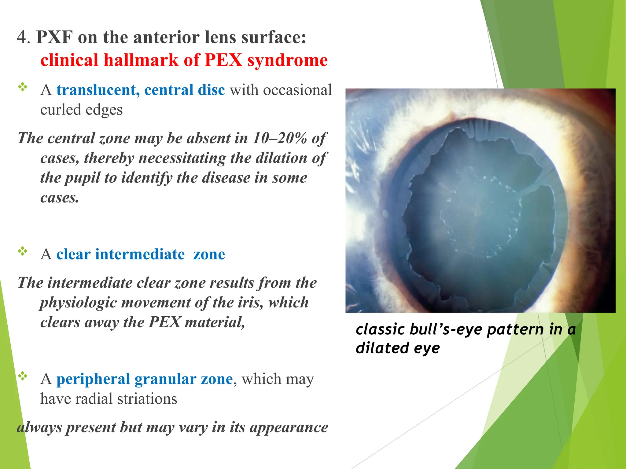 4. PXF on the anterior lens surface:
clinical hallmark of PEX syndrome
 A translucent, central disc with occasional
curled edges
The central zone may be absent in 10–20% of
cases, thereby necessitating the dilation of
the pupil to identify the disease in some
cases.
 A clear intermediate zone
The intermediate clear zone results from the
physiologic movement of the iris, which
clears away the PEX material,
 A peripheral granular zone, which may
have radial striations
always present but may vary in its appearance
classic bull’s-eye pattern in a
dilated eye
 