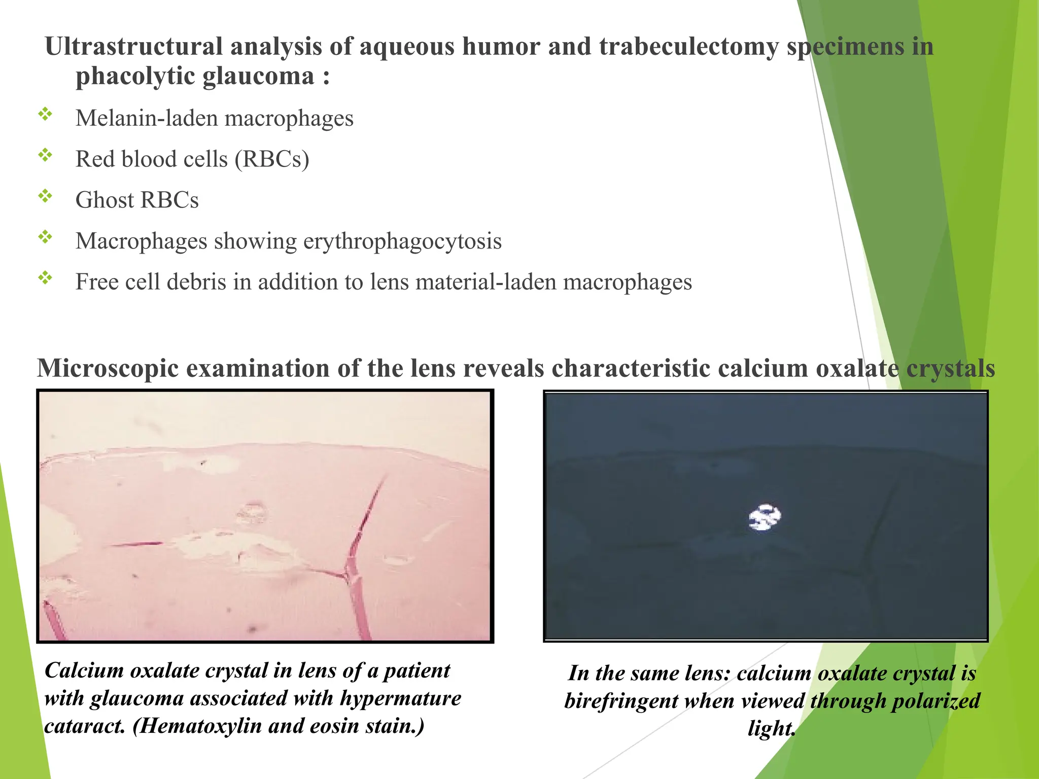 Ultrastructural analysis of aqueous humor and trabeculectomy specimens in
phacolytic glaucoma :
 Melanin-laden macrophages
 Red blood cells (RBCs)
 Ghost RBCs
 Macrophages showing erythrophagocytosis
 Free cell debris in addition to lens material-laden macrophages
Microscopic examination of the lens reveals characteristic calcium oxalate crystals
Calcium oxalate crystal in lens of a patient
with glaucoma associated with hypermature
cataract. (Hematoxylin and eosin stain.)
In the same lens: calcium oxalate crystal is
birefringent when viewed through polarized
light.
 