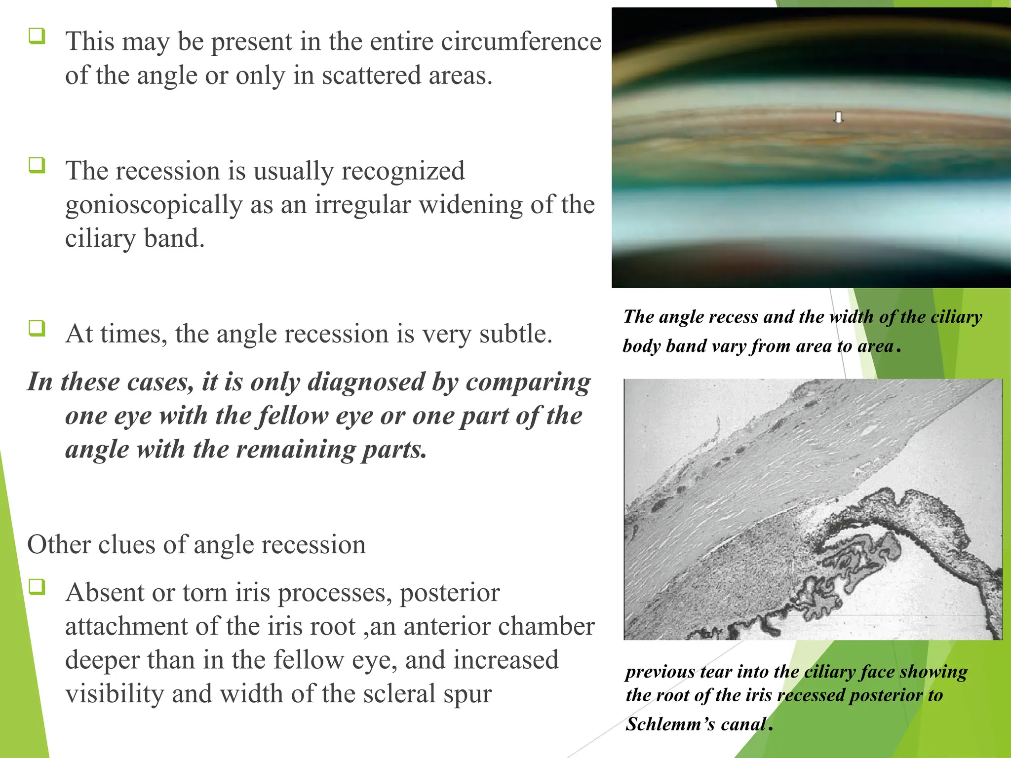  This may be present in the entire circumference
of the angle or only in scattered areas.
 The recession is usually recognized
gonioscopically as an irregular widening of the
ciliary band.
 At times, the angle recession is very subtle.
In these cases, it is only diagnosed by comparing
one eye with the fellow eye or one part of the
angle with the remaining parts.
Other clues of angle recession
 Absent or torn iris processes, posterior
attachment of the iris root ,an anterior chamber
deeper than in the fellow eye, and increased
visibility and width of the scleral spur
previous tear into the ciliary face showing
the root of the iris recessed posterior to
Schlemm’s canal.
The angle recess and the width of the ciliary
body band vary from area to area.
 