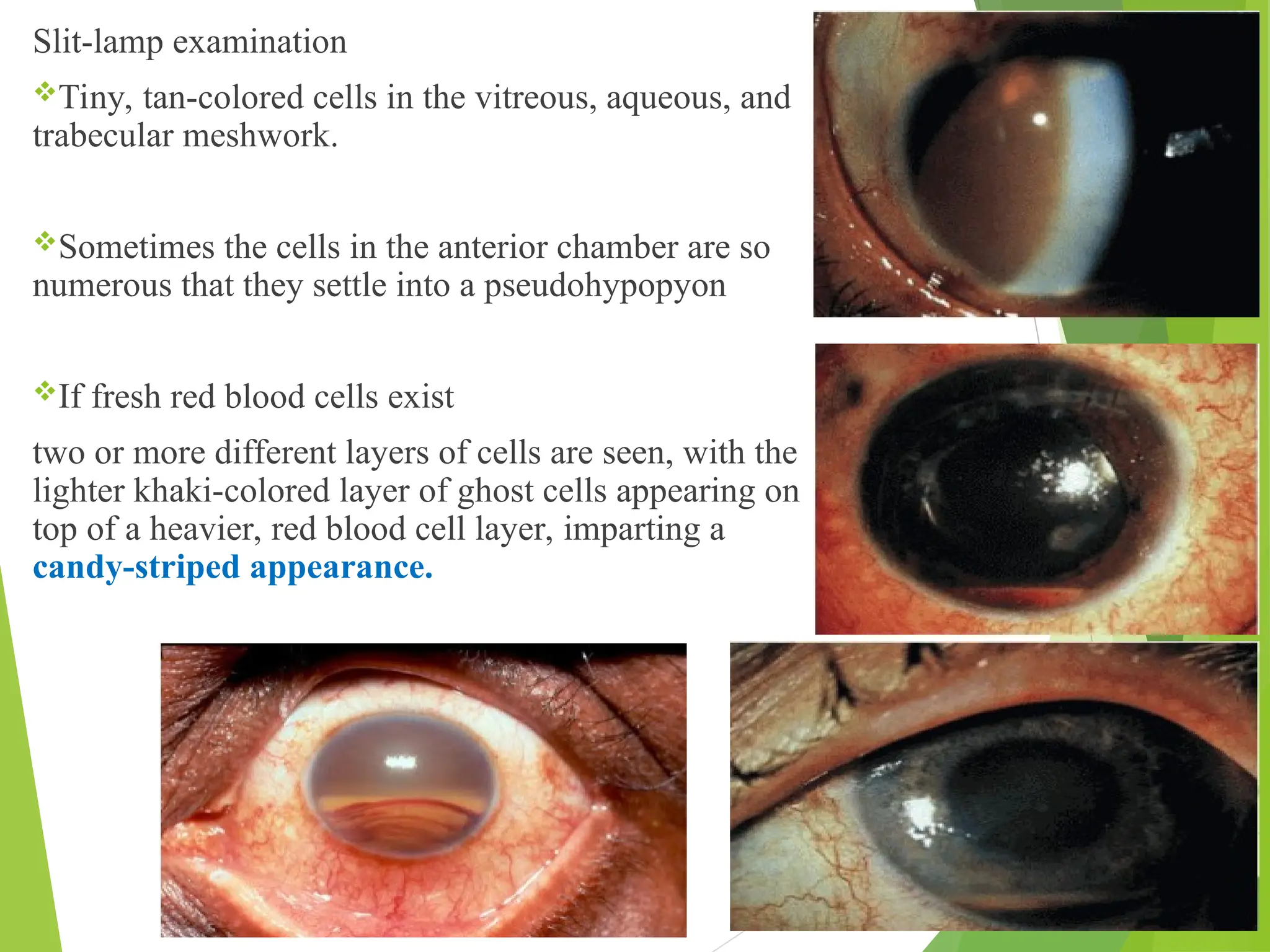 Slit-lamp examination
Tiny, tan-colored cells in the vitreous, aqueous, and
trabecular meshwork.
Sometimes the cells in the anterior chamber are so
numerous that they settle into a pseudohypopyon
If fresh red blood cells exist
two or more different layers of cells are seen, with the
lighter khaki-colored layer of ghost cells appearing on
top of a heavier, red blood cell layer, imparting a
candy-striped appearance.
 