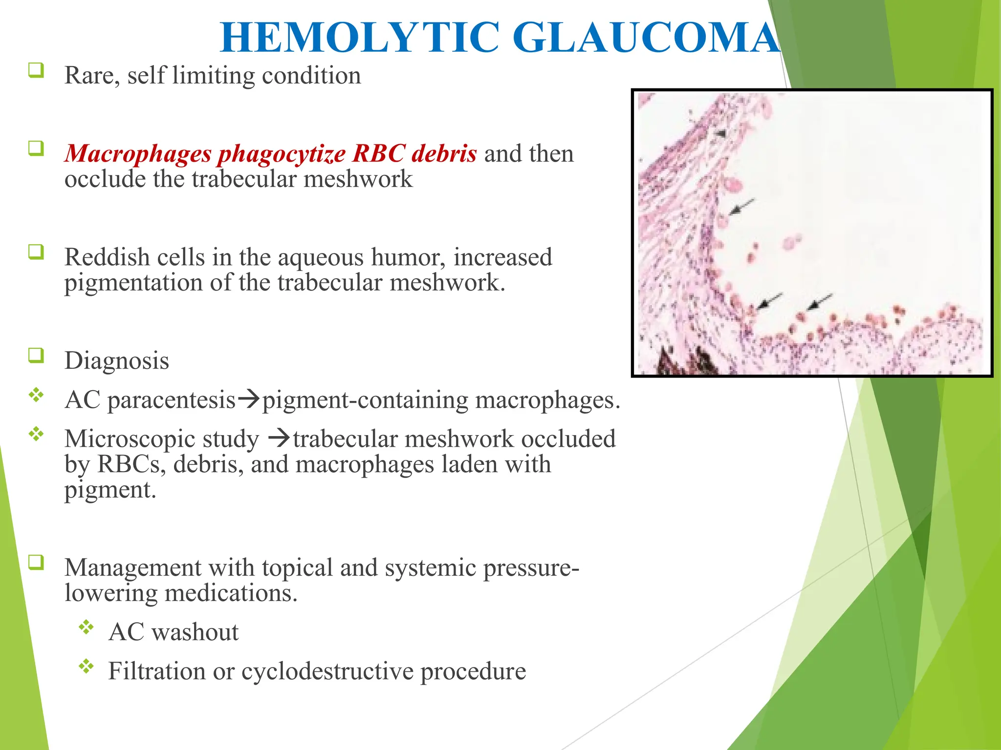 HEMOLYTIC GLAUCOMA
 Rare, self limiting condition
 Macrophages phagocytize RBC debris and then
occlude the trabecular meshwork
 Reddish cells in the aqueous humor, increased
pigmentation of the trabecular meshwork.
 Diagnosis
 AC paracentesispigment-containing macrophages.
 Microscopic study trabecular meshwork occluded
by RBCs, debris, and macrophages laden with
pigment.
 Management with topical and systemic pressure-
lowering medications.
 AC washout
 Filtration or cyclodestructive procedure
 