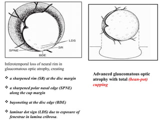 17.02 introduction to glaucoma and POAG.pptx