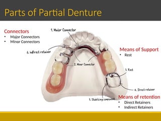 Direct Retainers In Rpd 17. Parts of Removable Partial Denture (RPD).pptx