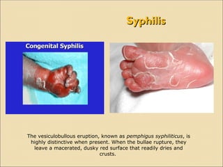 Syphilis Rash Crusts Over 17.TORCH infections notes for medical students.ppt