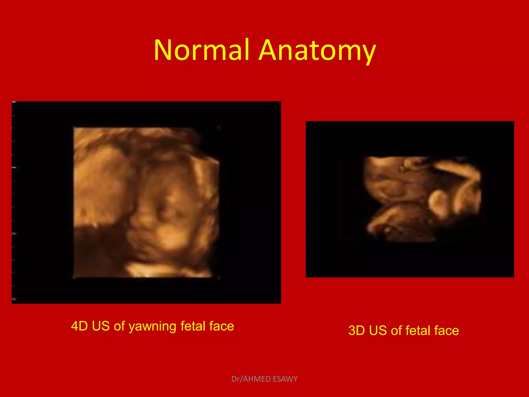 17-three D 4D fetal ultrasound Dr Ahmed Esawy | PDF