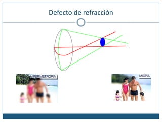 Defecto de refracción