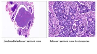 Comprehensive Overview of Pulmonary Carcinoid Tumors: Diagnosis and ...