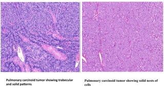 Comprehensive Overview of Pulmonary Carcinoid Tumors: Diagnosis and ...
