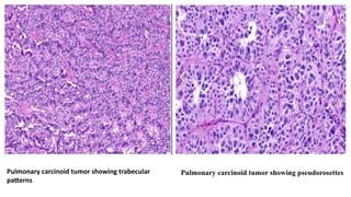 Comprehensive Overview of Pulmonary Carcinoid Tumors: Diagnosis and ...
