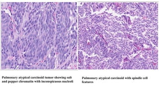 Comprehensive Overview of Pulmonary Carcinoid Tumors: Diagnosis and ...