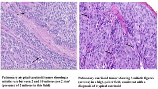 Comprehensive Overview of Pulmonary Carcinoid Tumors: Diagnosis and ...