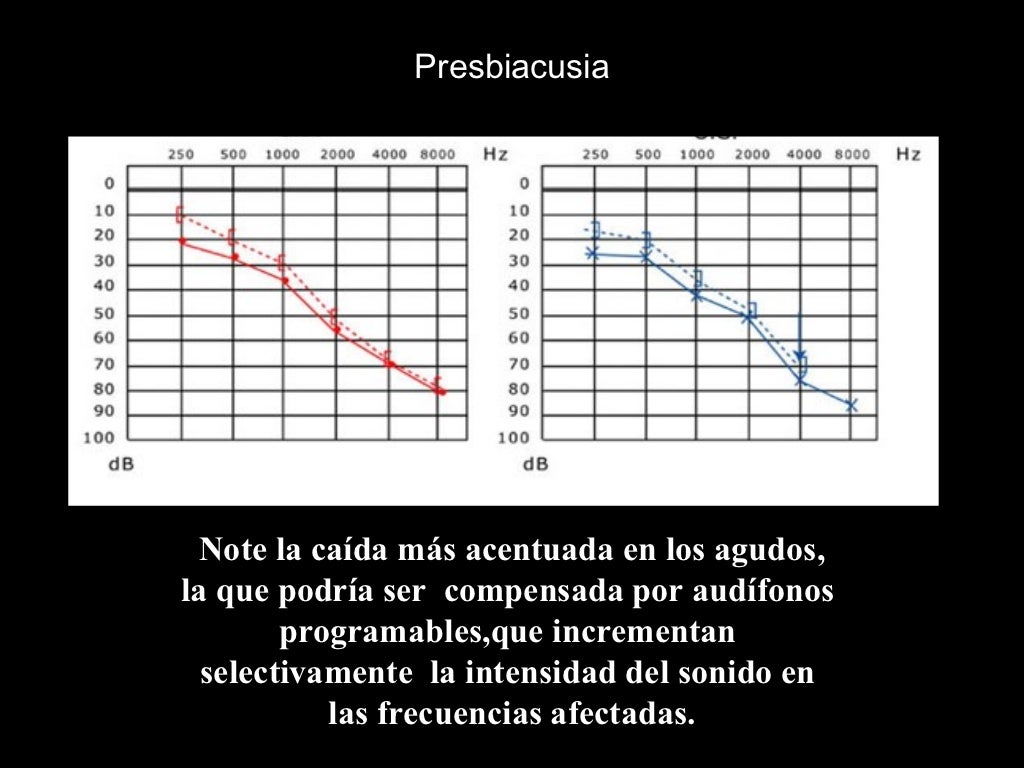 17.casos clinicos hipoacusias perceptivas