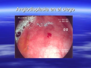 Angiodisplasia en el ciego 