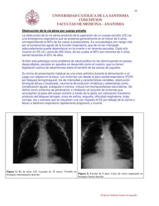 10
                                       UNIVERSIDAD CATOLICA DE LA SANTISIMA
                                                   CONCEPCION
                                         FACULTAD DE MEDICINA - ANATOMIA
             Obstrucción de la vía aérea por cuerpo extraño
             La obstrucción de la vía aérea producto de la aspiración de un cuerpo extraño (CE) es
             una emergencia respiratoria que se presenta generalmente en el menor de 5 años,
             correspondiendo el 80% de los casos a preescolares. Es una patología con riesgo vital
             por el compromiso agudo de la función respiratoria, que de no ser manejado
             adecuadamente puede desembocar en la muerte o en severas secuelas. Cada año
             mueren en EE.UU. cerca de 300 niños, de los cuales el 90% son menores de 5 años,
             siendo lactantes el 65% de ellos.

             Si bien esta patología como problema de salud pública ha ido disminuyendo en países
             desarrollados, persiste en aquellos en desarrollo como el nuestro, que no tienen
             legislación acerca de advertencias sobre el tamaño de las piezas de juguetes.

             Su forma de presentación habitual es una crisis asfíctica durante la alimentación o el
             juego con objetos en la boca. Los síntomas van desde el paro cardiorrespiratorio (PCR)
             por bloqueo laringotraqueal, tos de intensidad y características variables, obstrucción
             bronquial difusa o localizada, neumonía de evolución inhabitual y atelectasias como
             complicación aguda, subaguda o crónica, incluso con bronquiectasias secundarias. Se
             define como síndrome de penetración o inhalación al conjunto de síntomas que
             acompañan al paso del cuerpo extraño a través de la glotis con sofocación transitoria
             producto del bloqueo laríngeo, crisis de asfixia, angustia, dificultad respiratoria, tiraje,
             cornaje, tos y cianosis que se resuelven una vez migrado el CE por debajo de la carina o
             llevan a deterioro respiratorio rápidamente progresivo y muerte.




Figura 1: Rx de tórax A.P. Lactante de 18 meses. Tornillo en
bronquio intermediario derecho.                              Figura 2: Escolar de 6 años. Carro de cierre impactado en
                                                             bronquio fuente derecho




                                                                                 Profesor Gabriel Astete Arriagada
 