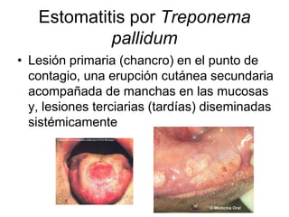 Estomatitis por Treponema
pallidum
• Lesión primaria (chancro) en el punto de
contagio, una erupción cutánea secundaria
acompañada de manchas en las mucosas
y, lesiones terciarias (tardías) diseminadas
sistémicamente
 