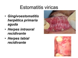 Estomatitis viricas
• Gingivoestomatitis
herpética primaria
aguda
• Herpes intraoral
recidivante
• Herpes labial
recidivante
 