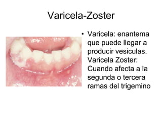 Varicela-Zoster
• Varicela: enantema
que puede llegar a
producir vesiculas.
Varicela Zoster:
Cuando afecta a la
segunda o tercera
ramas del trigemino
 