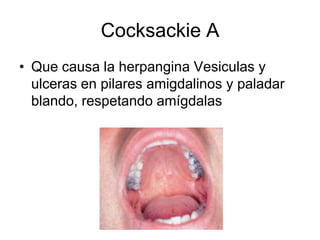 Cocksackie A
• Que causa la herpangina Vesiculas y
ulceras en pilares amigdalinos y paladar
blando, respetando amígdalas
 