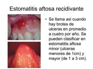 Estomatitis aftosa recidivante
• Se llama asi cuando
hay brotes de
ulceras en promedio
a cuatro por año. Se
pueden clasificar en
estomatitis aftosa
minor (ulceras
menores de 1cm) y
mayor (de 1 a 3 cm).
 