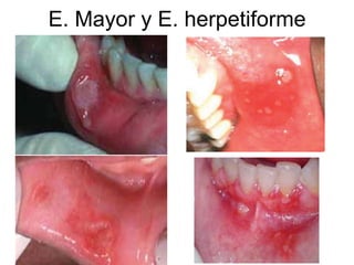 E. Mayor y E. herpetiforme
 