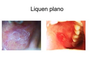 Liquen plano
 
