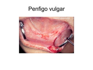 Penfigo vulgar
 