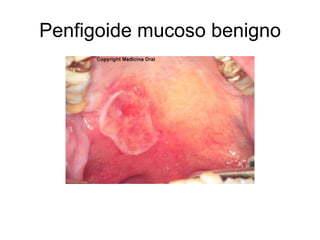 Penfigoide mucoso benigno
 