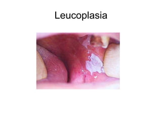 Leucoplasia
 