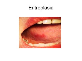 Eritroplasia
 