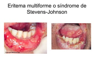 Eritema multiforme o síndrome de
Stevens-Johnson
 