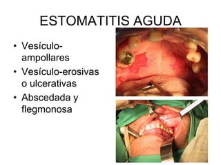 ESTOMATITIS AGUDA
• Vesículo-
ampollares
• Vesículo-erosivas
o ulcerativas
• Abscedada y
flegmonosa
 