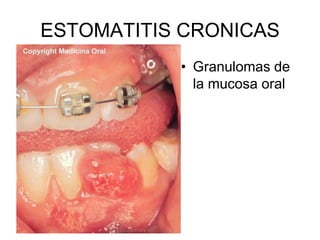 ESTOMATITIS CRONICAS
• Granulomas de
la mucosa oral
 