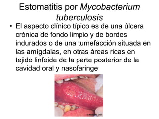 Estomatitis por Mycobacterium
tuberculosis
• El aspecto clínico típico es de una úlcera
crónica de fondo limpio y de bordes
indurados o de una tumefacción situada en
las amígdalas, en otras áreas ricas en
tejido linfoide de la parte posterior de la
cavidad oral y nasofaringe
 